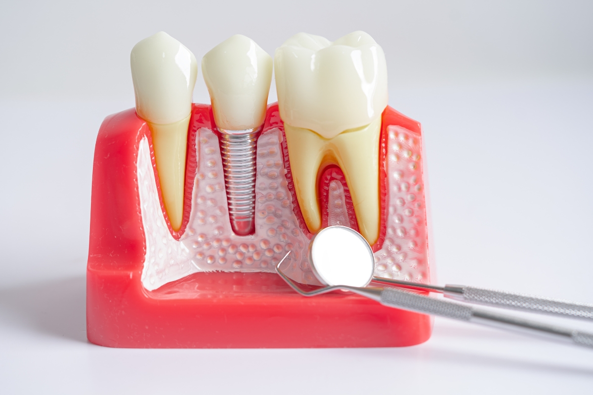 Dental Implants Austin