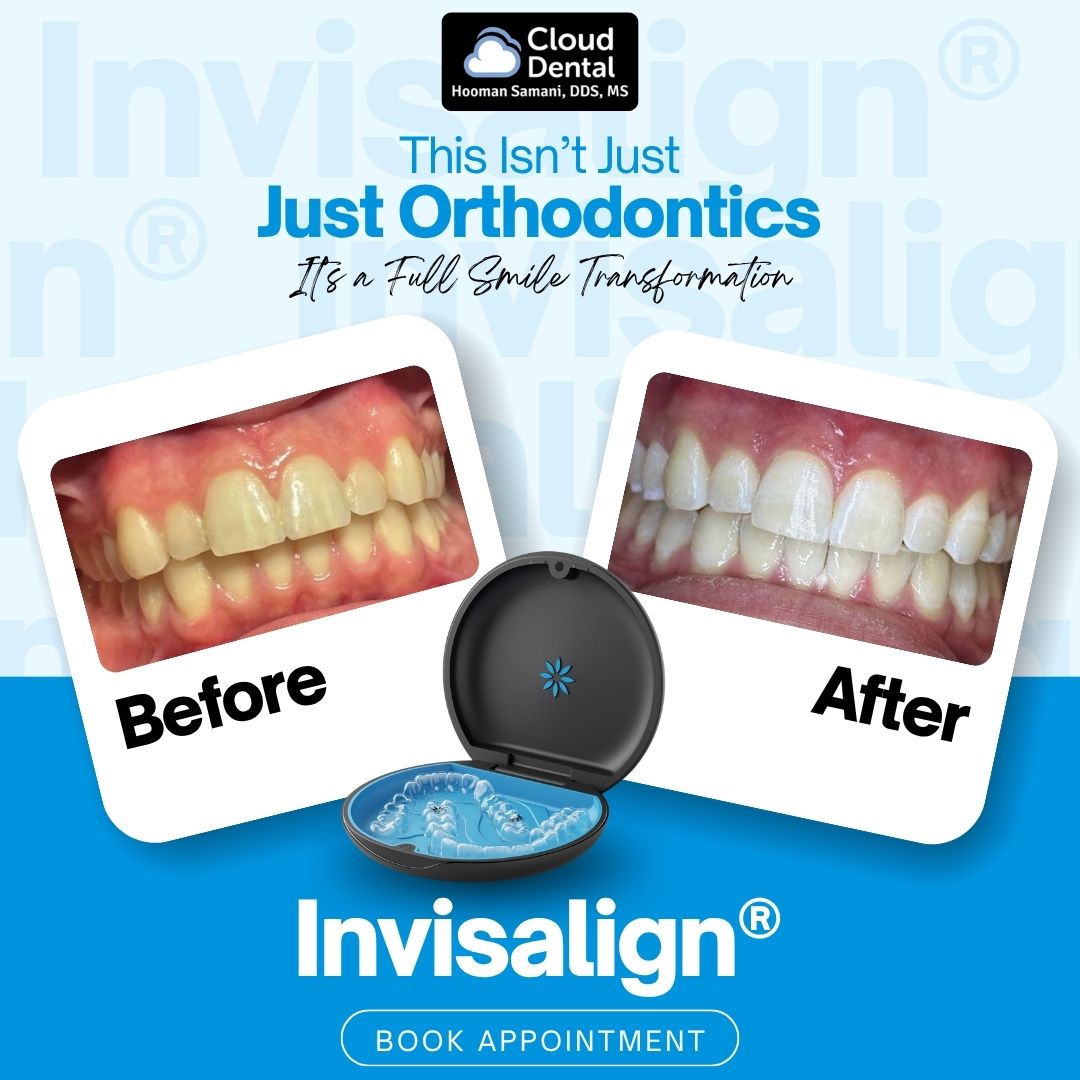 Invisalign before and after — Cloud Dental Austin patient results